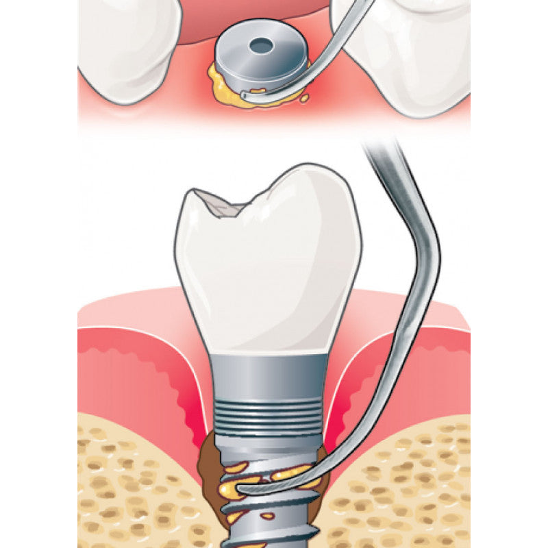 Acteon IP1 pure titanium implant ultrasonic tip