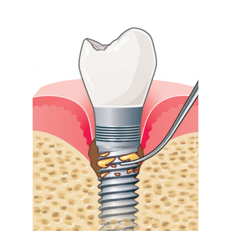 Acteon IP2L left-oriented pure titanium implant ultrasonic tip
