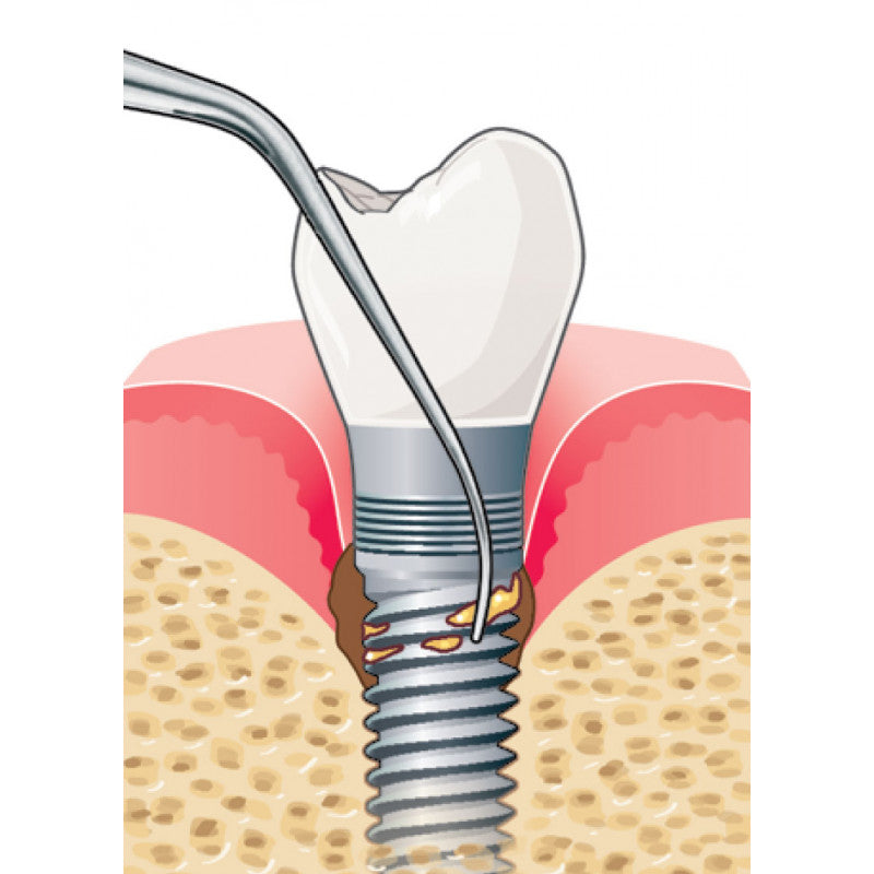Acteon IP2R right-oriented pure titanium implant ultrasonic tip
