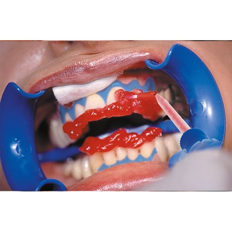 Schütz Dental Bleach'n Smile Automix in-office whitening system