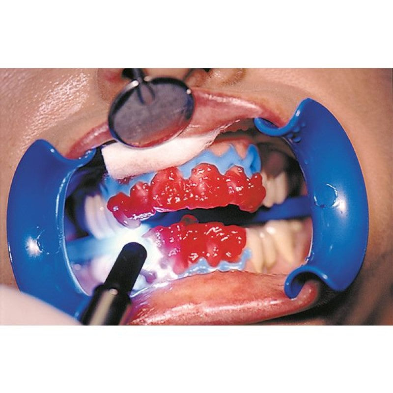 Schütz Dental Bleach'n Smile Automix in-office whitening system