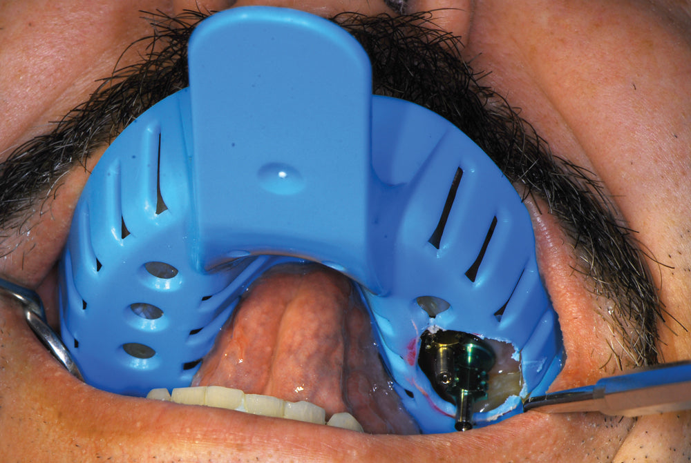 Miratray Implant