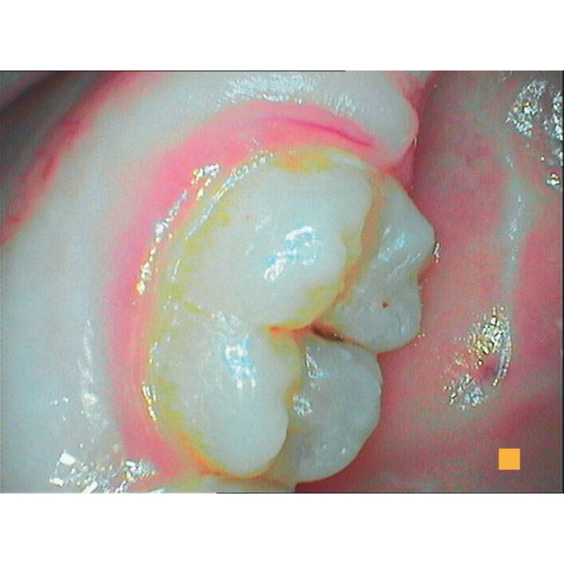 Acteon SoproCare intraoral camera