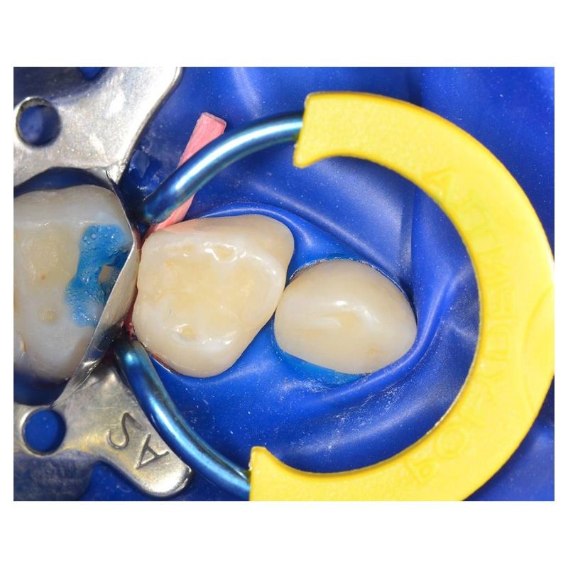 Polydentia myJunior pediatric sectional matrix kit
