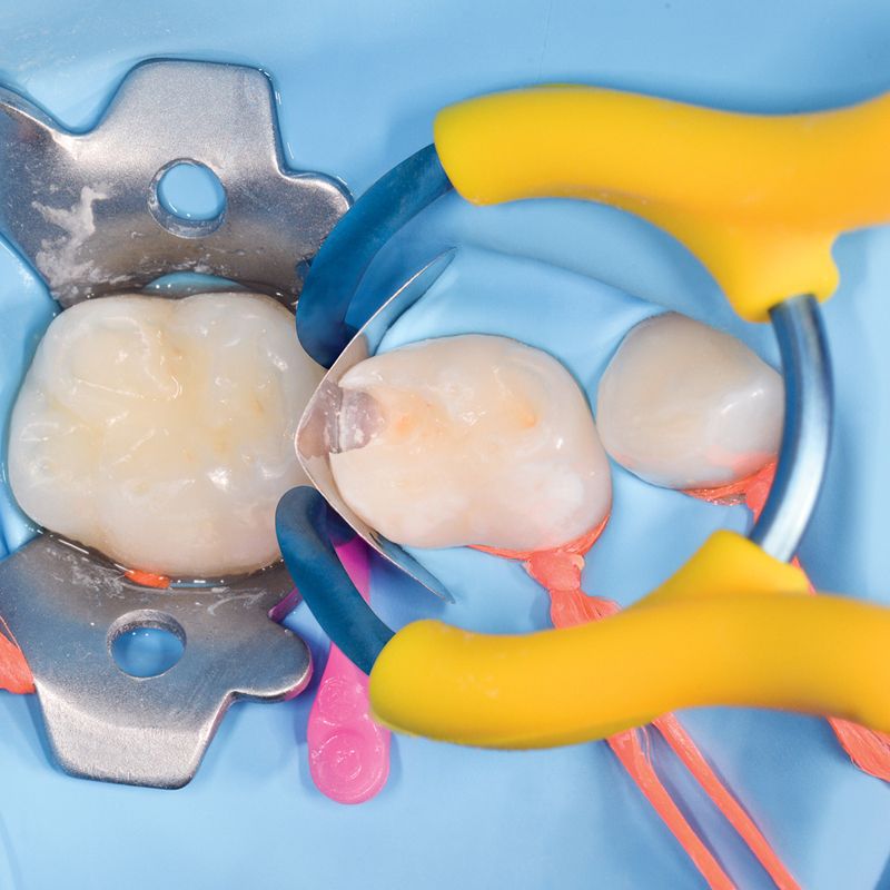 Polydentia MyClip Junior paediatric sectional matrix ring